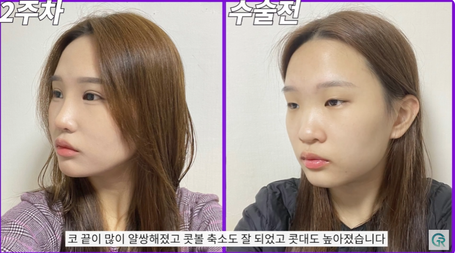 [기린성형외과] 작고 답답한 눈, 뭉뚝하고 낮은 복코 탈출!_눈성형, 코성형 수술일지 관련 이미지 9