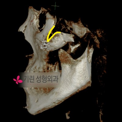 안면윤곽 후 부작용증상 1. 광대불유합 관련 이미지 3