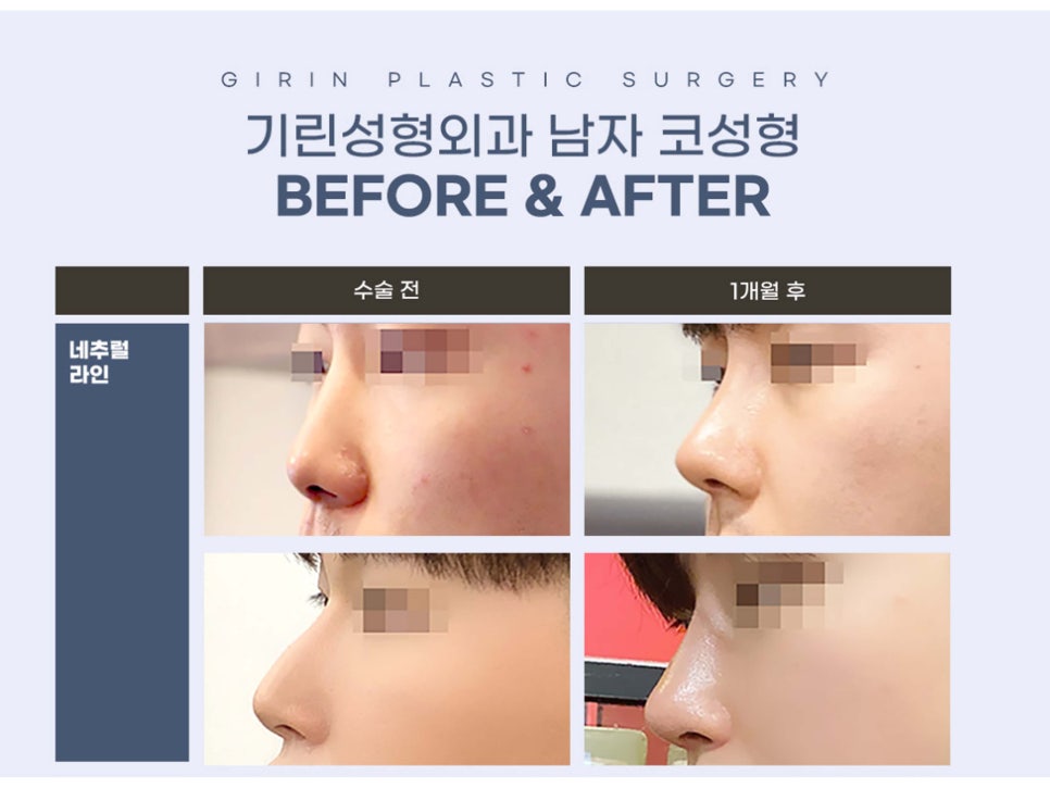 남자코수술전후 주의해서 선택을 관련 이미지 3