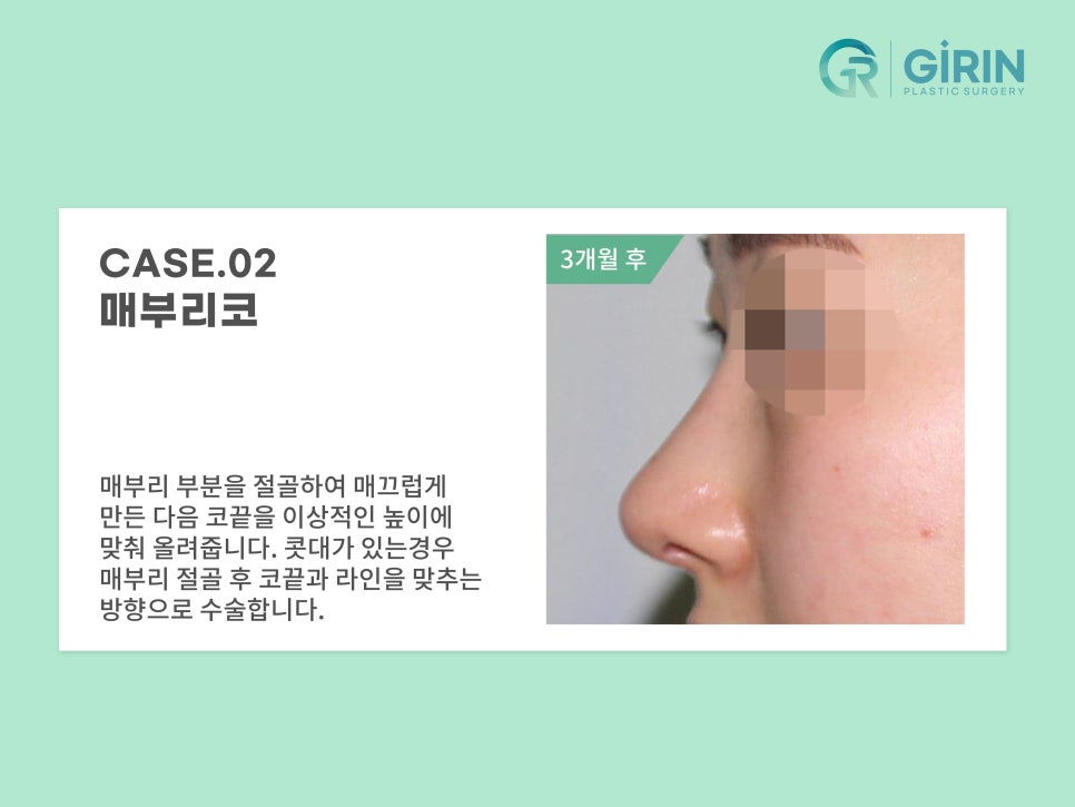 코성형 종류 비교하고 맞춰서 관련 이미지 9