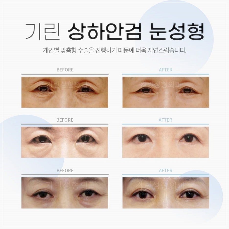 비절개상안검수술 처진중년눈성형 이젠 고민만 하지말자! 관련 이미지 5