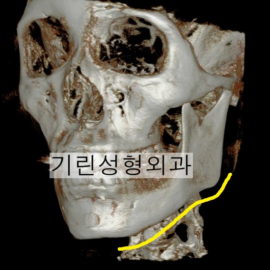앞턱 끝까지 자르는 긴곡선절제술 (전후CT) 관련 이미지 1