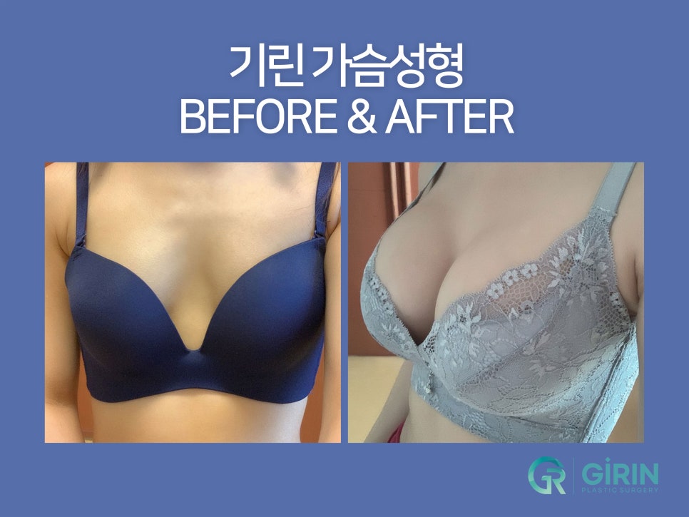가슴확대수술 효율성 따져보며 관련 이미지 1