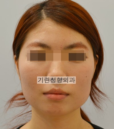 윤곽수술 시 심부볼제거 관련 이미지 1