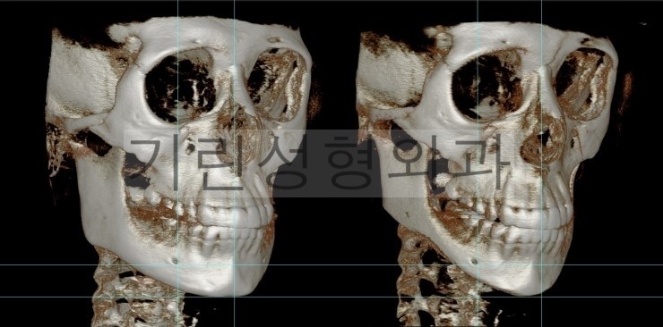 퇴원시 촬영한 긴곡선사각턱 CT영상/ 8일차 경과사진 관련 이미지 3