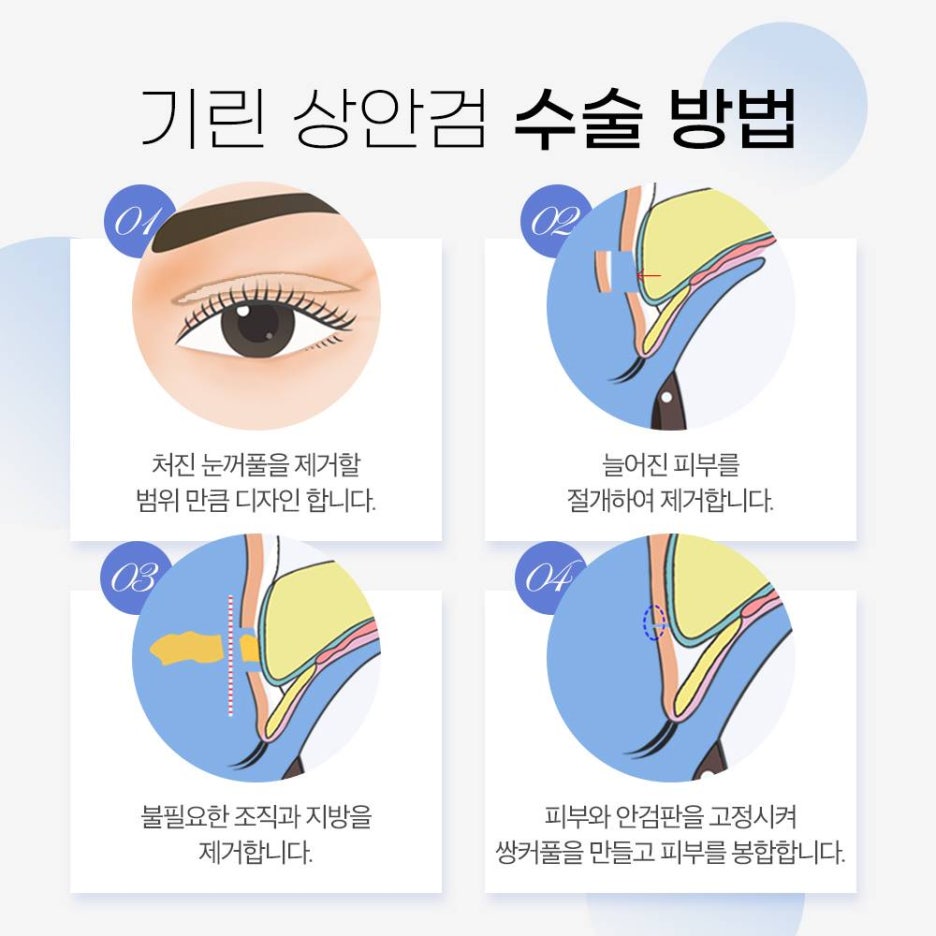 기린성형외과 안티에이징 눈성형 특별한 무엇? 관련 이미지 4