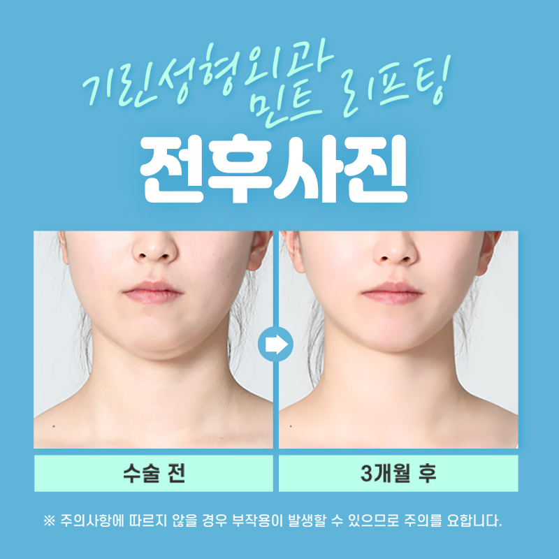 소개팅 전날, 예뻐지자! 원데이 민트실리프팅 관련 이미지 10