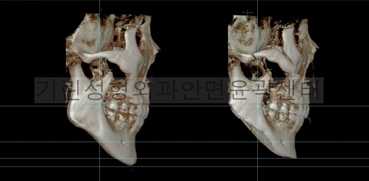 긴곡선 앞턱길이줄임+광대고정 관련 이미지 5