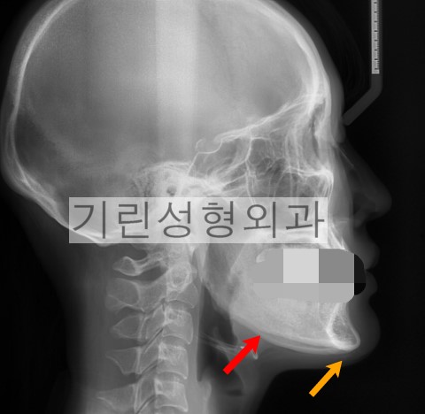 귀뒤사각턱수술 후 부작용: 효과없는 경우 관련 이미지 2