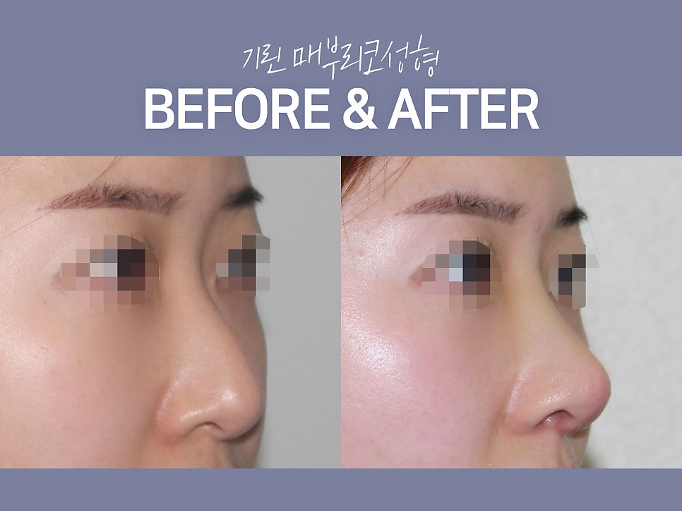 매부리코수술후기 방법까지 확인해 관련 이미지 5
