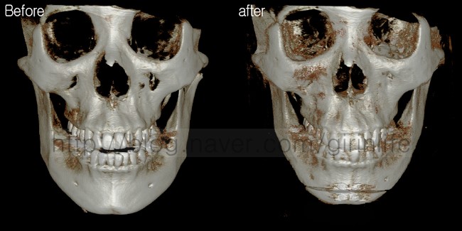 긴턱줄이는 수술 : 샌드위치절골사례 관련 이미지 1