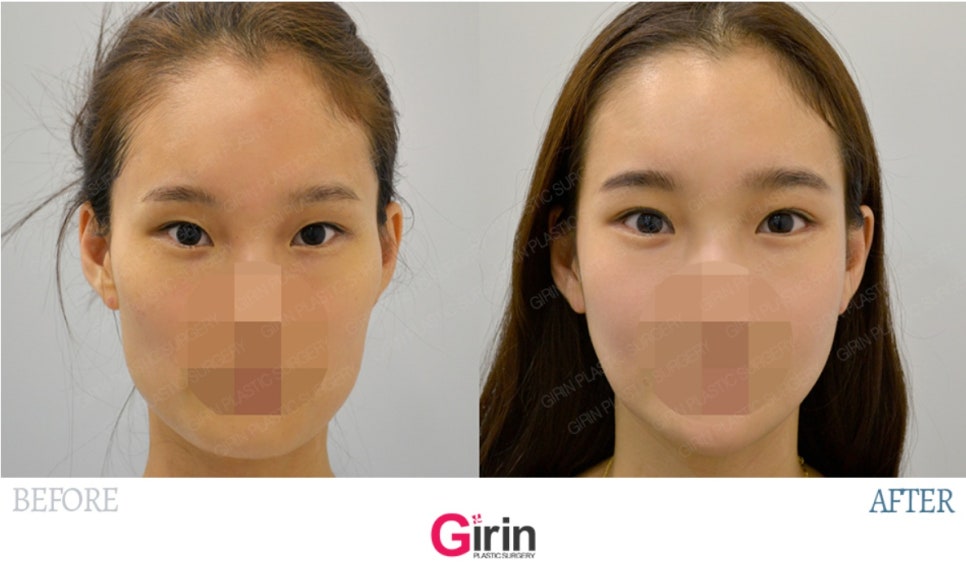 요즘 누가 티나게 성형하니? 기린성형외과 자연유착으로 미모완성♥(+후기) 관련 이미지 11