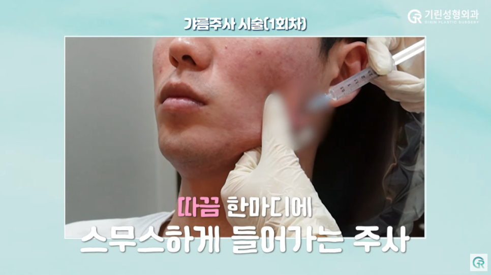 [기린성형외과의원] 수술 없이 턱라인 개선하기_인모드와 지방분해주사 관련 이미지 7