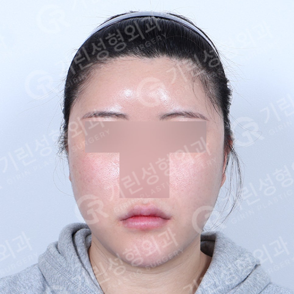 [기린성형외과의원] 누운귀 칼귀 작은귀 고민 해결_엘프귀 요정귀 귀필러 관련 이미지 7