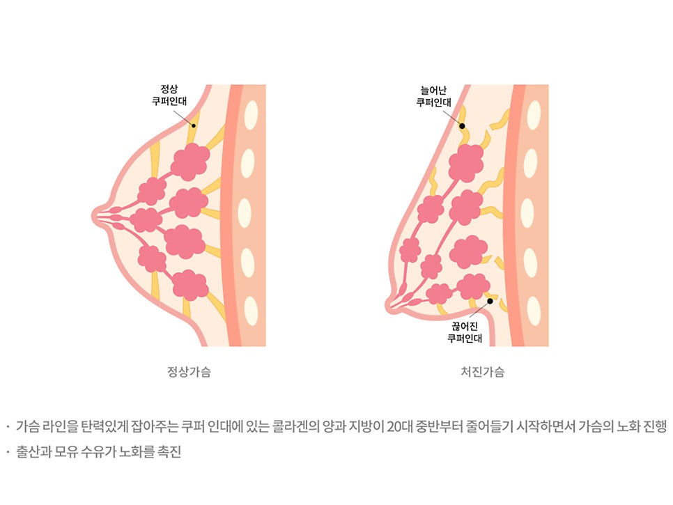 출산후 가슴수술 필요하다 느낀다면 관련 이미지 4