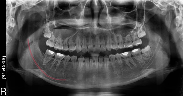 사각턱수술 시 신경선의 위치 (파노라마로 보이는 신경선) 관련 이미지 1