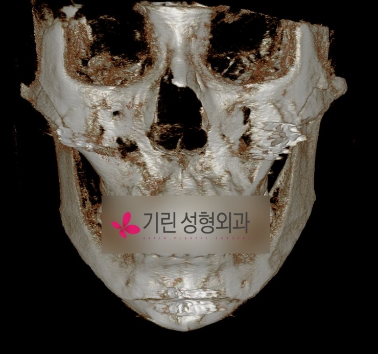 넓은앞턱 줄이기 위한 앞턱수술 [앞턱수술후 뼈_bone] 관련 이미지 2