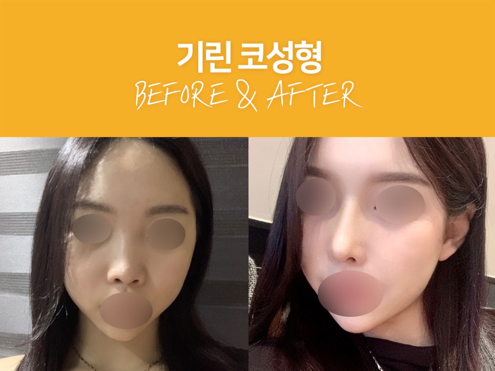 여자코성형후기 얼굴 비율까지 고려하여 관련 이미지 6