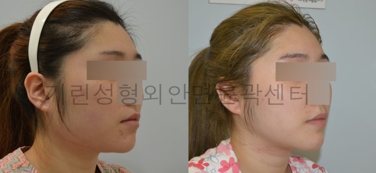 긴곡선+아큐스컬프+귀족수술 7게월 경과 관련 이미지 3