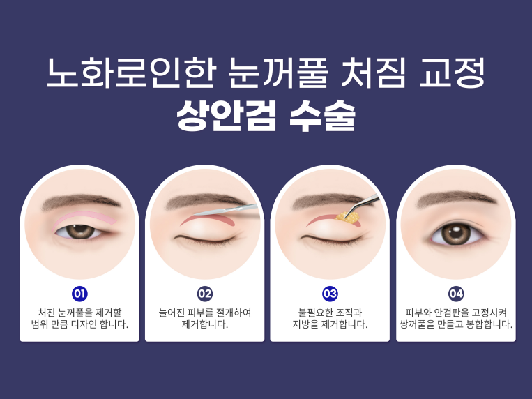 상하안검수술 인상을 바꾸기 위해 관련 이미지 9
