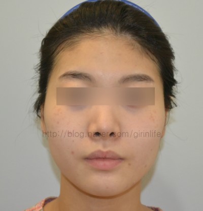 긴곡선 후 하관의 변화 ~한달 관련 이미지 1