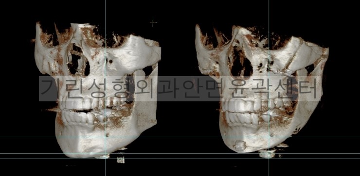남자긴턱줄임+자가뼈앞턱수술+광대고정 수술다음날CT 관련 이미지 5