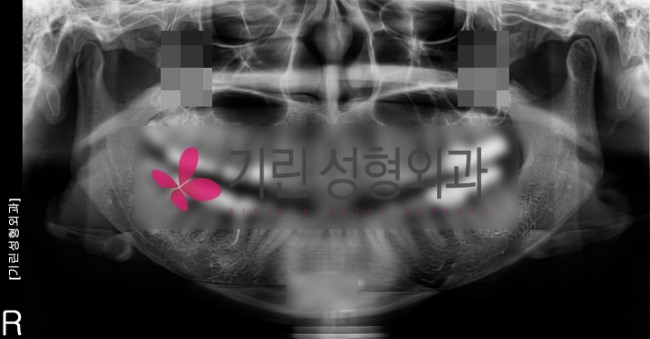 사각턱재수술 - 이차각의 제거 관련 이미지 2