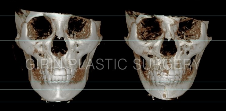 비대칭교정, 긴턱교정 22일경과 관련 이미지 3