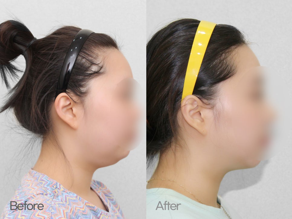 이중턱성형 차이가 궁금하다면 관련 이미지 8