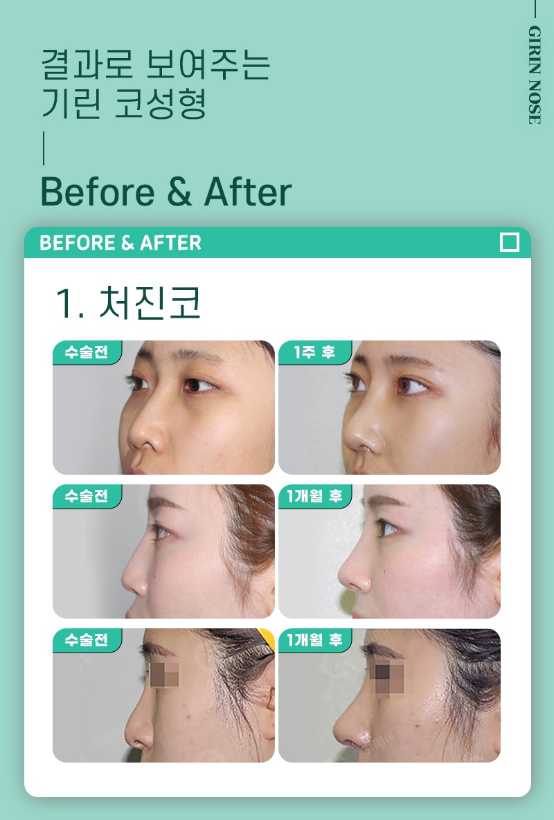 코성형수술비용 확실한 기준으로 정확하게 관련 이미지 1