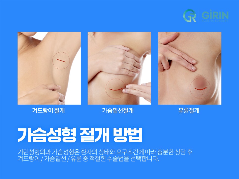 유방확대술 고려하고 있다면 관련 이미지 4
