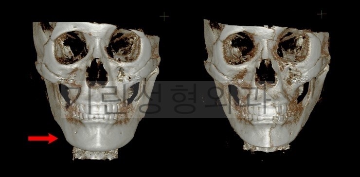 어제 재수술한 환자분의 3DCT입니다. 관련 이미지 1