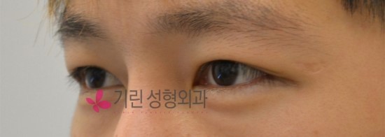 남자 쌍꺼풀수술 자연스럽게 ★ 관련 이미지 4