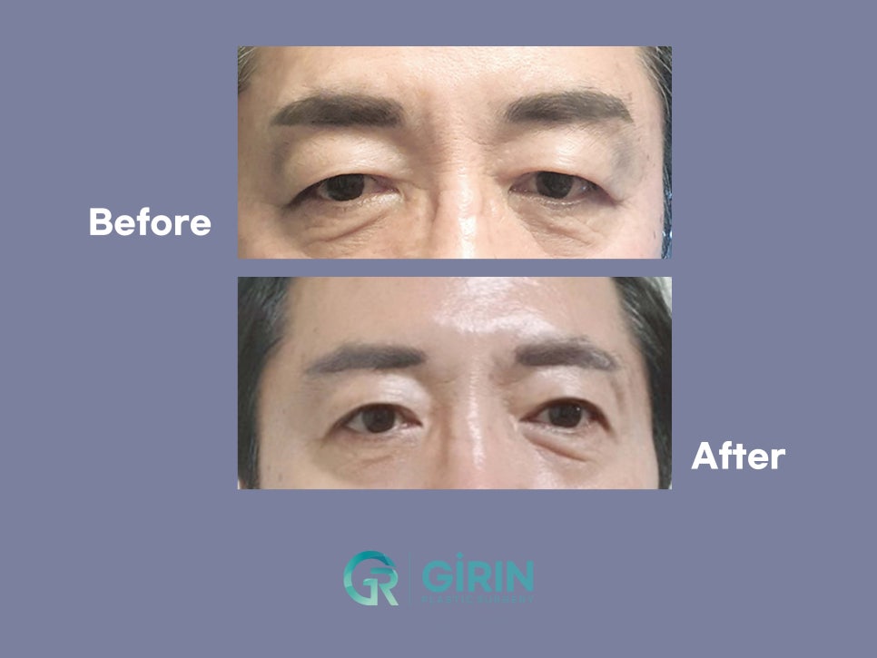 중년눈성형잘하는곳 찾았다면 관련 이미지 11