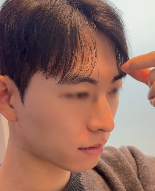 남자 미니젤리코 사례로 보는 코시술 후기 관련 이미지 7