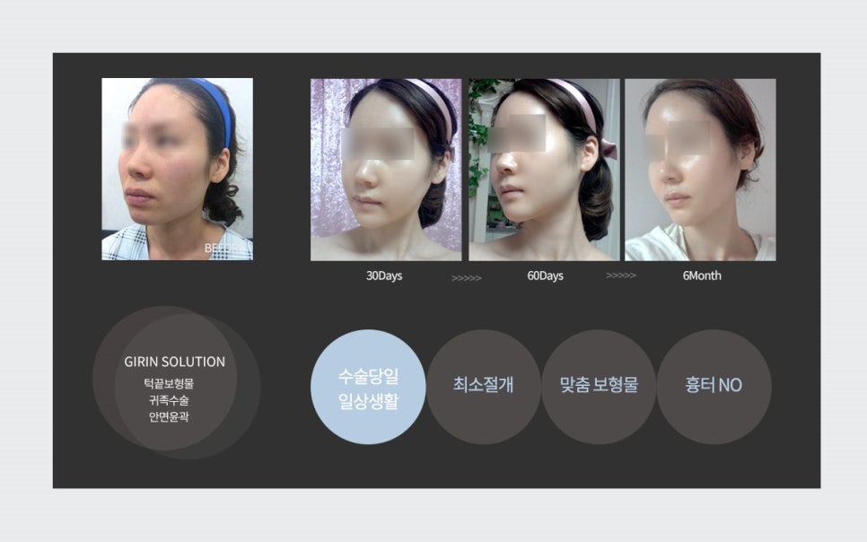 돌출입 수술, 꼭 양악으로 해결해야 할까? 관련 이미지 3