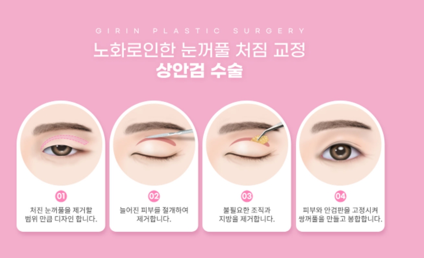 상안검수술잘하는곳 이유가 있다! 관련 이미지 5