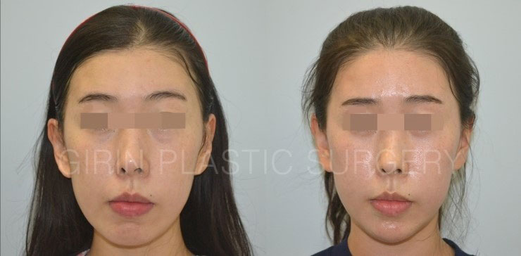 긴곡선절제술 6주차 앞턱변화 모습 관련 이미지 1