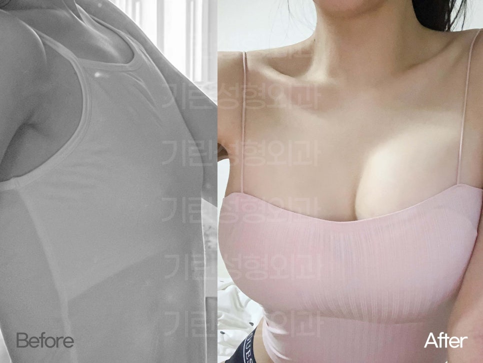 강남가슴수술 촉감과 라인도 중요하니까 관련 이미지 2
