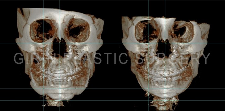 양악수술후 이차각, 라인불균형으로 인한 재수술 관련 이미지 1