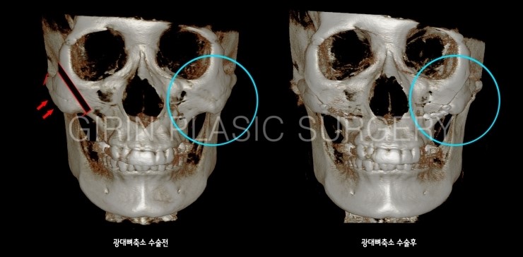 45도광대, 옆광대축소수술 전후 3DCT비교 관련 이미지 1
