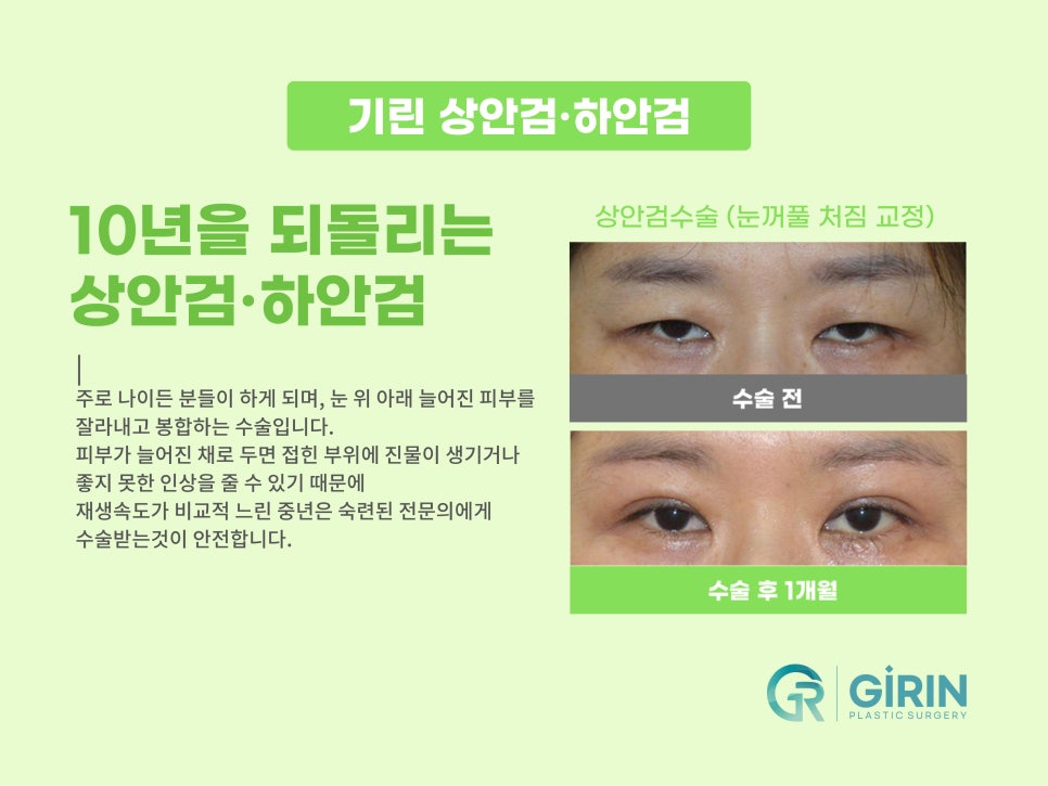 상안검수술잘하는곳 알아본다면 관련 이미지 3