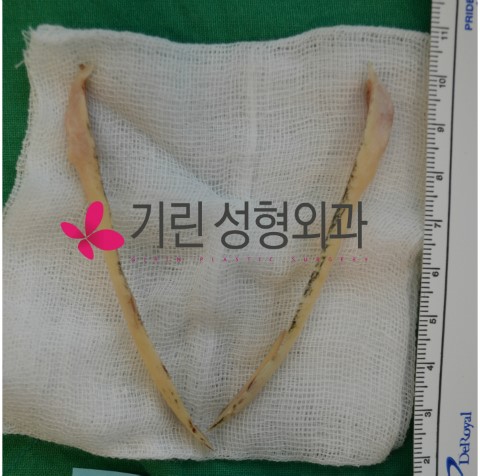 브이라인(수술후bone) - 많이 자른다고 많이 갸름해지나요? 관련 이미지 1