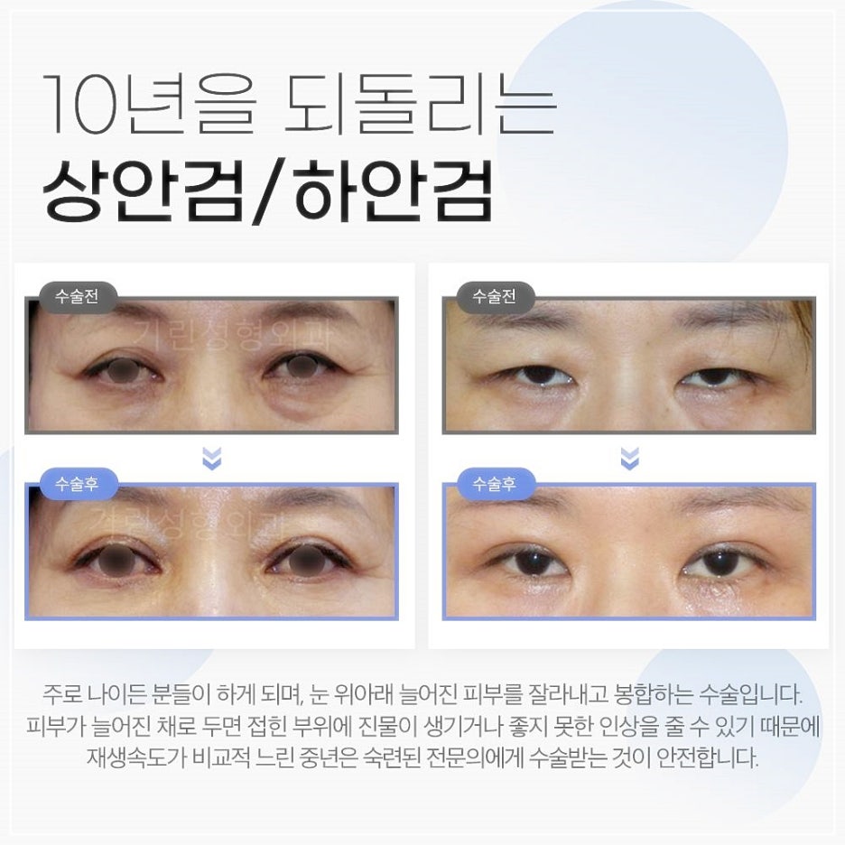 비절개상안검수술 처진중년눈성형 이젠 고민만 하지말자! 관련 이미지 3