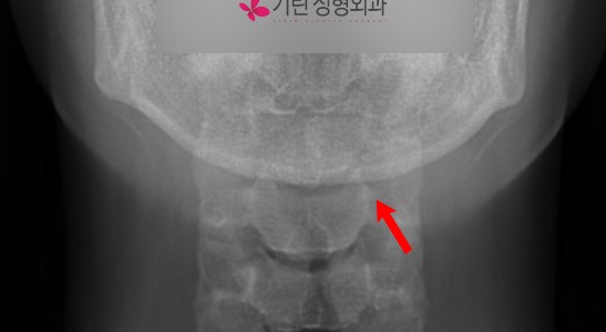 사각턱수술 후 어디까지 잘라냈는지 엑스레이를 보고 알 수 있을까? (피질골절제술 시행여부 판단방법) 관련 이미지 3