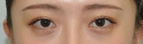 뒤트임 눈성형수술, 기린만의 특별화된 7mm 뒤트임. 관련 이미지 3