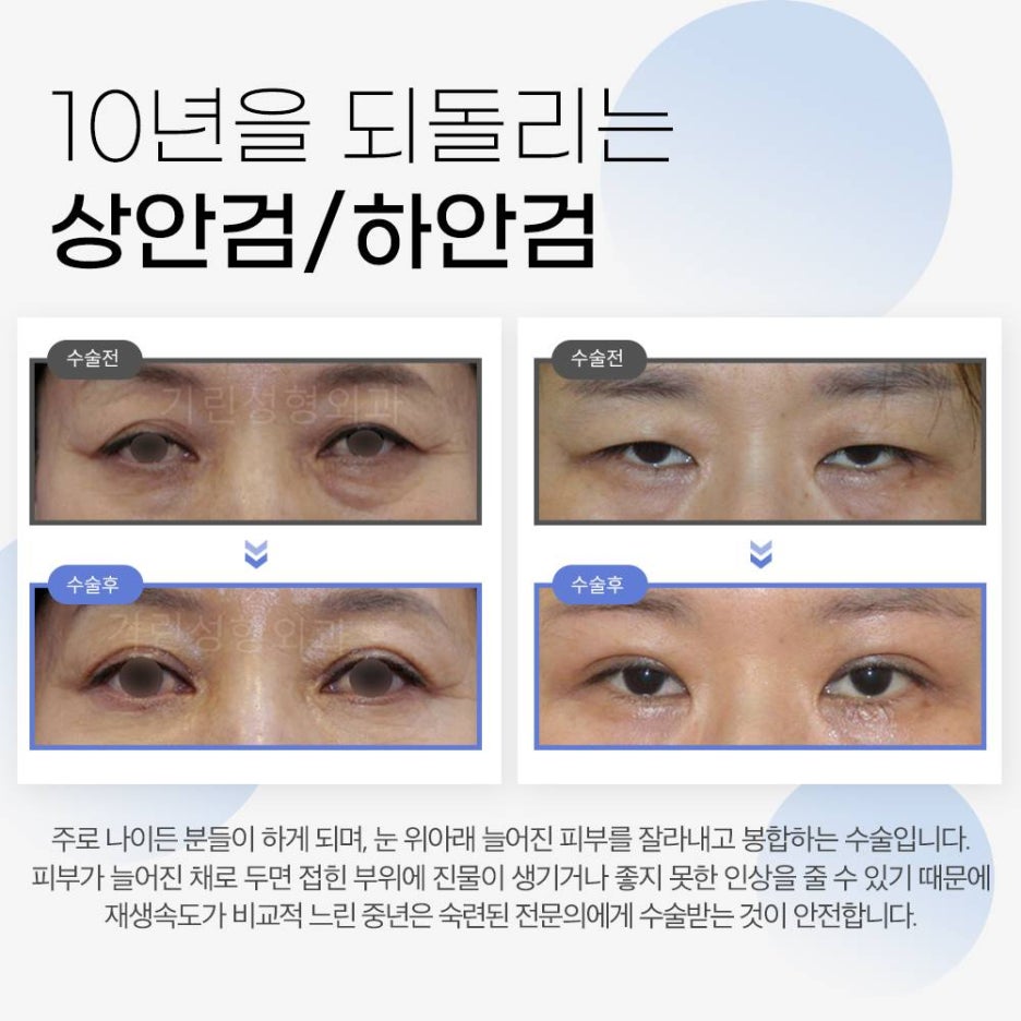기린성형외과 안티에이징 눈성형 특별한 무엇? 관련 이미지 2