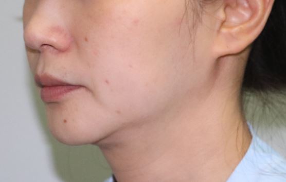 비수술 리프팅, 어떤 종류가 있을까? 관련 이미지 2