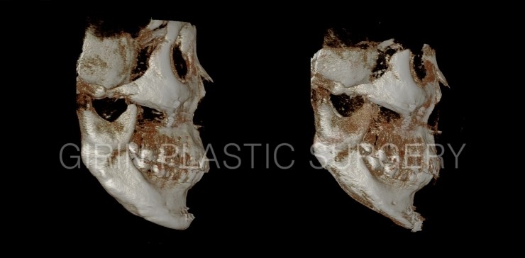 티절골재수술사례 관련 이미지 3