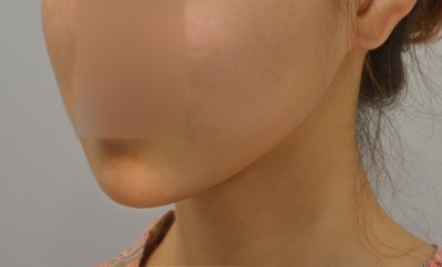 긴턱,무턱,돌출된 복합케이스 양악수술만이 답이 아니다. 관련 이미지 2